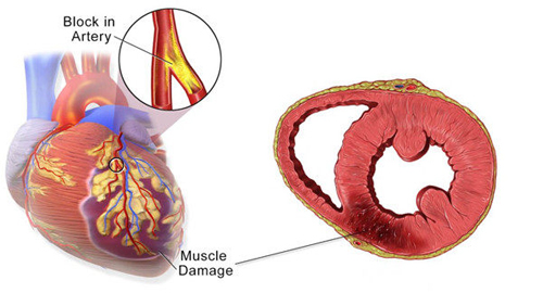 Acerca de infarto de miocardio